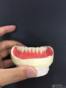 全口假牙视频