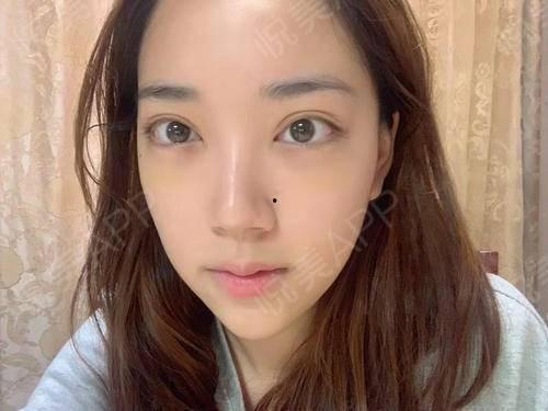 激光去眼袋视频全过程,术前术后护理与效果展示